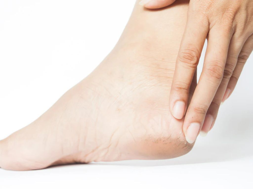 Ini 5 Tips Atasi Tumit Kaki yang Pecah-pecah, Tapi Simak Dulu Penyebabnya!