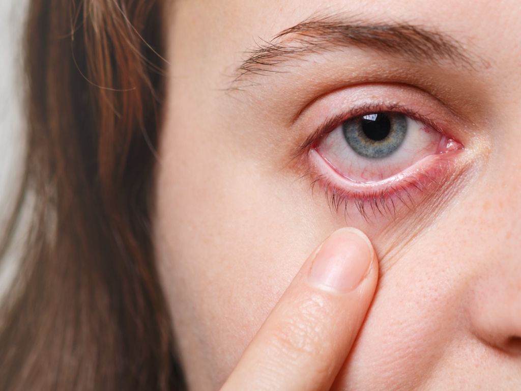 Sering Kena Alergi Mata? Berikut Tips Dokter untuk Redakan Cepat