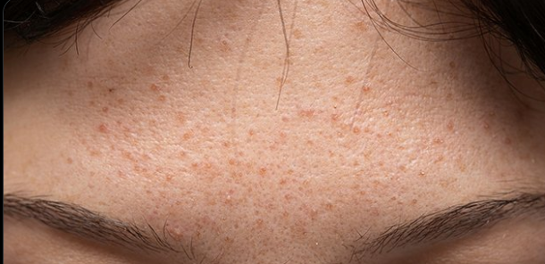 9 Cara Efektif Atasi Wajah Bruntusan Tanpa ke Klinik