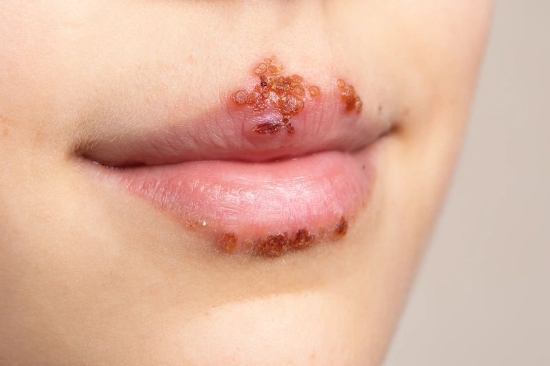 Jangan Salah! Herpes Gak Cuma dari Hubungan Intim Biasa, Tapi Bisa Juga Lewat Seks Oral