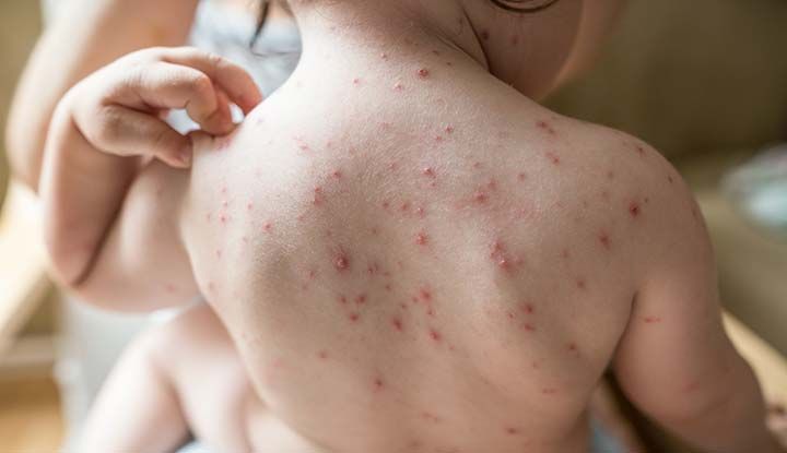 7 Infeksi Kulit yang Disebabkan Karena Virus, Jangan Dianggap Sepele!