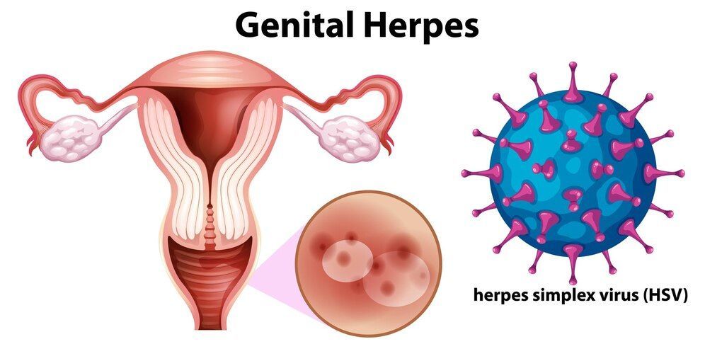 Jangan Anggap Remeh! Ini 6 Fakta Penting Herpes Genital yang Jarang Diketahui